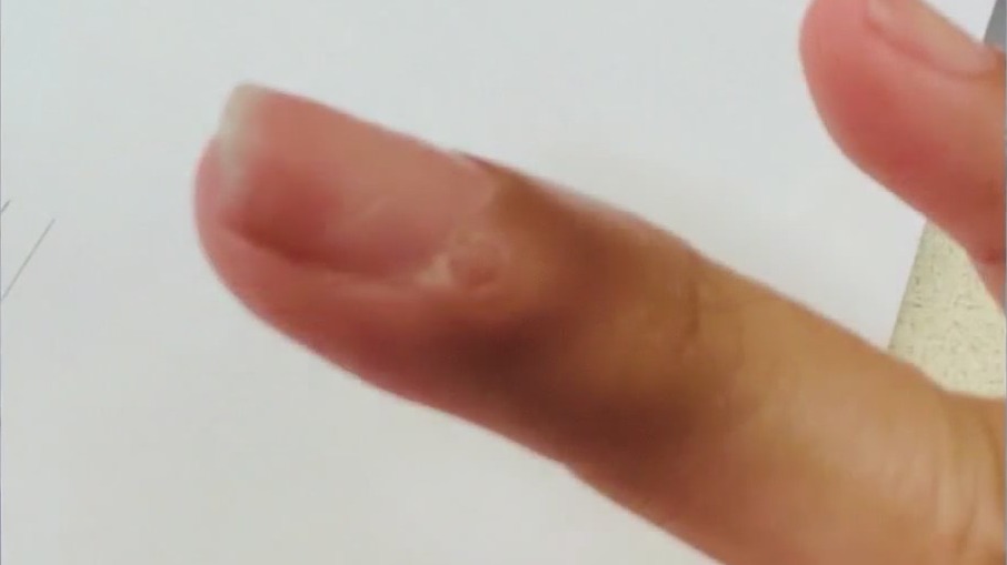 Doctor says manicure gave woman cancer under her fingernail